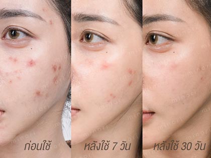 Before-After-acne